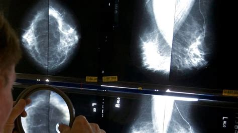 Ontario lowering age for regular breast cancer screenings to 40